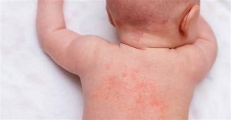 Heat Rash On Baby Causes And Treatment Bellybelly