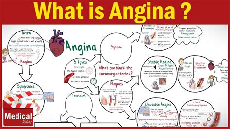Pharmacology What Is Angina Pectoris Types Of Angina Symptoms