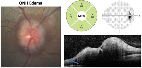 Lesson Understanding Onh Dynamics In Glaucoma And Beyond