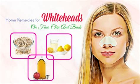 25 Home Remedies For Whiteheads On Face Chin And Back