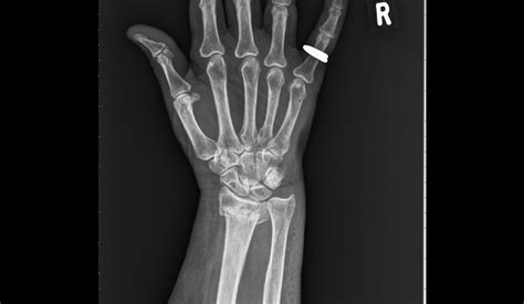 Wrist Fracture Surgery And Treatment Cape Town