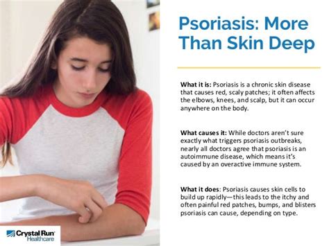 Living With Psoriasis Managing The Condition For Better Quality Of Life