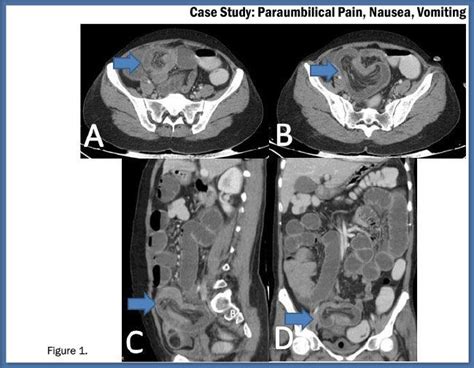 Paraumbilical Pain Nausea Vomiting Diagnostic Imaging