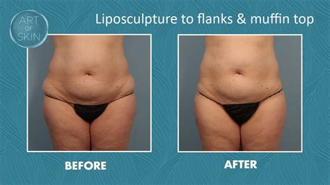 Flanks Lipo Before And After Amardeeplexxy