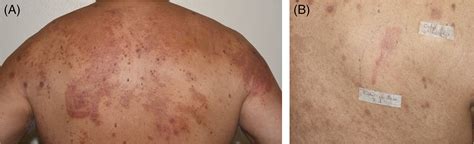 Allergic Contact Dermatitis Caused By Octylisothiazolinone In A Leather