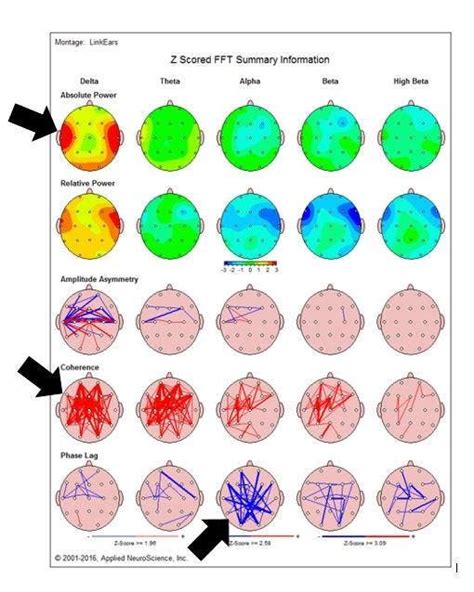 Qeeg Testing Is The Gps Map Of The Brain Plainview Ny Patch