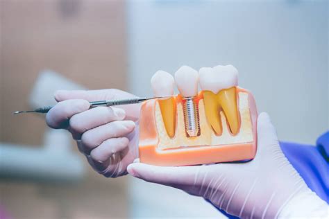 How Long Do Dental Implants Last Mccue Dental Health