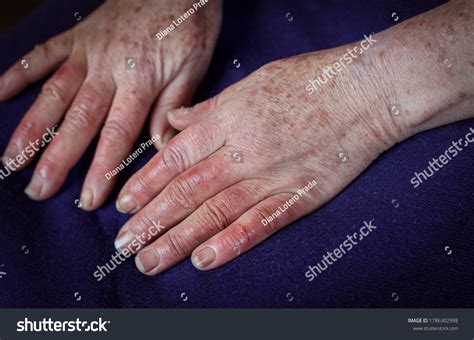 Closeup Womans Reddened Hands Wounds Raynauds Stock Photo 1786302998