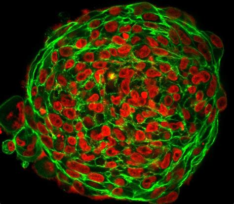 How Cancer Cells Shape Shift To Squeeze Through Tissue • Healthcare In