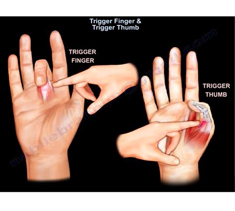 Trigger Finger And Trigger Thumb —