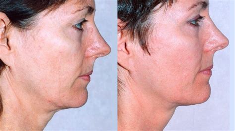 Radio Frequency Laser Skin Tightening London Buckingamshire Ultherapy Morpheus Intracel
