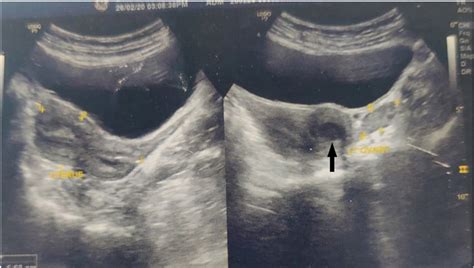 Sonographic Finding Of A Bicornuate Uterus With An Anechoic Collection