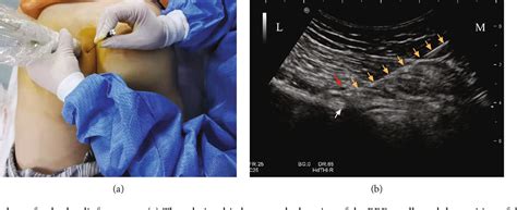 Figure 3 From Therapeutic Efficacy Of Ultrasound Guided High Voltage