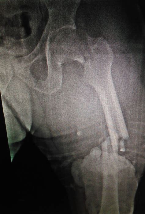 Femoral Neck Fractures Trauma Orthobullets 49056 The Best Porn Website