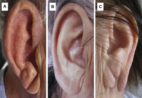 Earlobe Crease Shapes And Cardiovascular Events American Journal Of