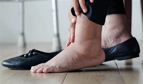 How To Stop Feet And Ankles Swelling In Hot Weather 7 Steps To
