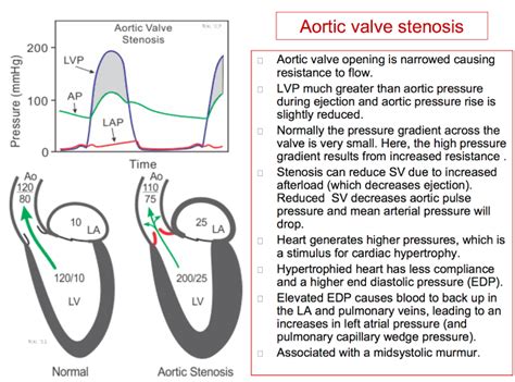Aortic Valve Mean Pressure Gradient Medcoo