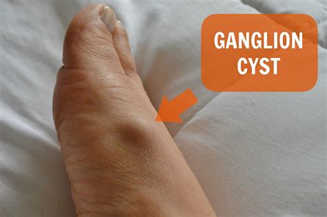 Ganglion Cyst On Bottom Of Foot Treatment Of Ganglion Cysts Some Porn
