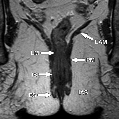 cross sectional imaging of the anal sphincter in fecal incontinence ajr