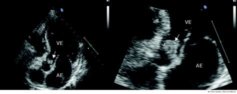 Fungal Endocarditis With Central And Peripheral Embolization Case
