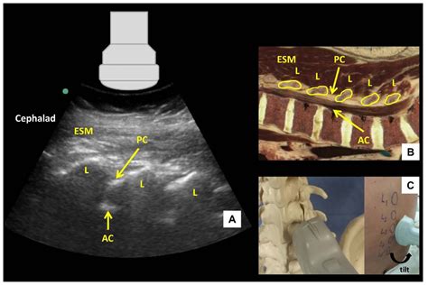 Ultrasound Guided Lumbar Central Neuraxial Blockade