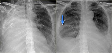 Total Atelectasis The Chest X Ray Shows Total Atelectasis Grepmed