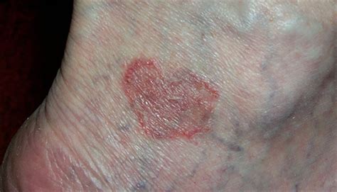 Derm Dx Erythematous Annular Patch With Atrophic Center Clinical