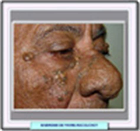 The disease was originally described in 1932 by favre 1. El síndrome de Favre-Racouchot es un desorden ocasionado ...