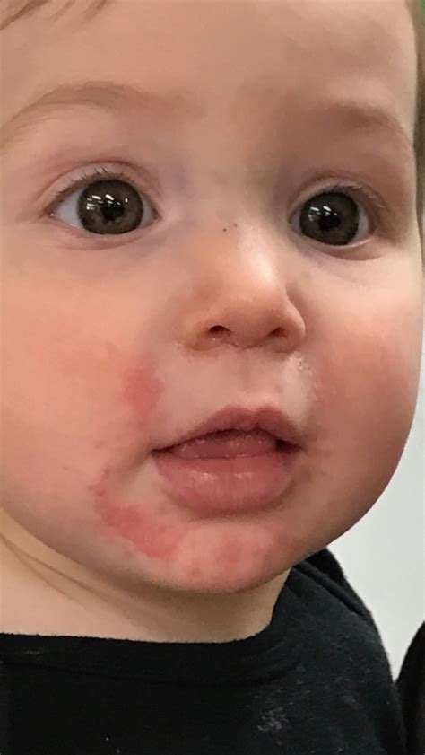 My Baby Has A Rash Around His Mouth Baby Viewer