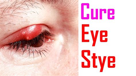 How To Treat Eye Stye How To Get Rid Of Eye Stye Youtube