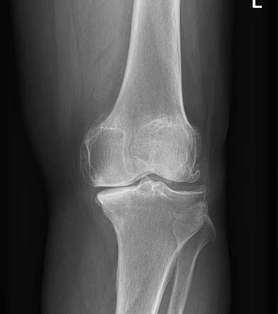 Kellgren And Lawrence System For Classification Of Osteoarthritis