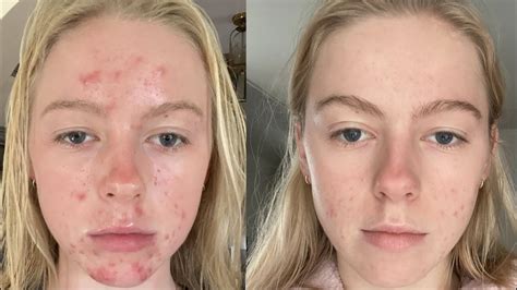 My Accutane Experience What Didnt Work Pictures Youtube