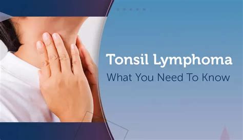 Tonsil Lymphoma What You Need To Know Mylymphomateam