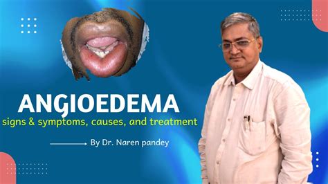 Angioedema Signs And Symptoms Causes And Treatment Angioedema Lips