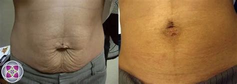 Stretch Marks Before And After Laser