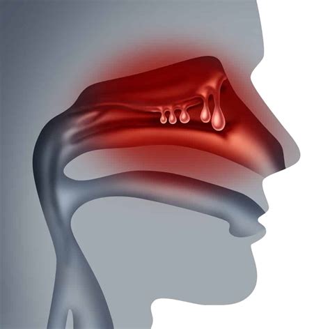 Nasal Polyps Treatment Causes Symptoms Risk Factors And Prevention