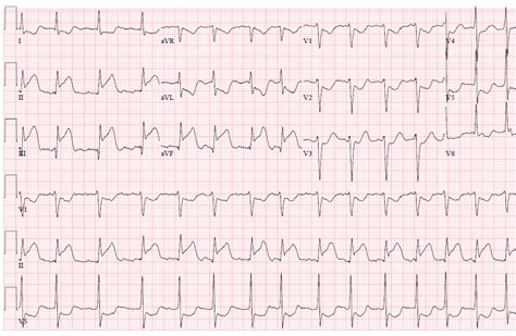 With stemi and nstemi have different initial. CCL at Wake Forest University - School of Medicine - StudyBlue