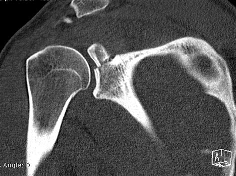 Arthroscopic Screw Fixation Technique For Transverse Glenoid Fractures