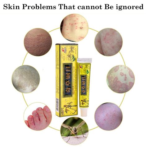 5pcs Natural Chinese Herbal Cream Eczemapsoriasis Creams Dermatitis
