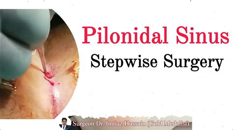 Pilonidal Sinus Stepwise Surgery Explained Surgeon Dr Imtiaz