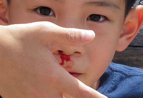 Nasal Trauma Broken Nose And Epistaxis Nosebleed In Children