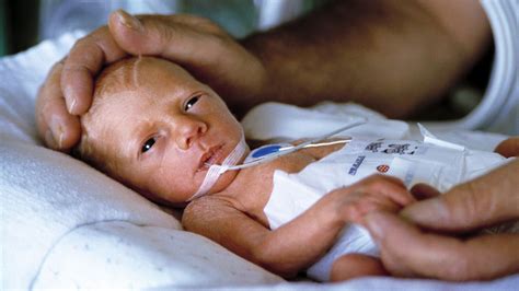 Survival Rate Improving For Extremely Preterm Babies Preterm Baby