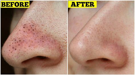 Get Rid Of Blackheads Instantly Easiest And Effective Home Remedy
