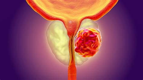 Radiotherapy Plus Hormone Therapy Boosts Prostate Cancer Outcomes