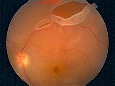 Check spelling or type a new query. Retina Surgery | Retinal Tear Treatment | Retinal ...