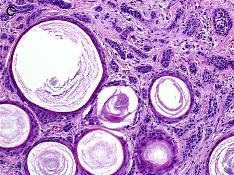 Update On Malignant Sweat Gland Tumors Surgical Pathology Clinics