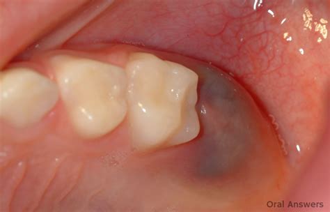 Eruption Cyst Photos Of A Purple Bump On The Gums Oral Answers