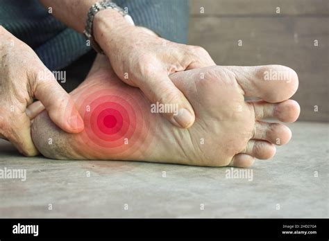 Concept Of Nail Prick And Cellulitis In Foot Of Asian Young Man