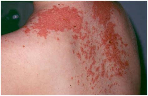 Maculopapular Rash Causes Symptoms Pictures Treatment Diagnosis