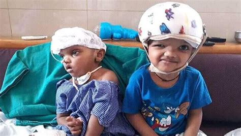 1 Of Conjoined Twins Separated In Indias First Craniopagus Surgical